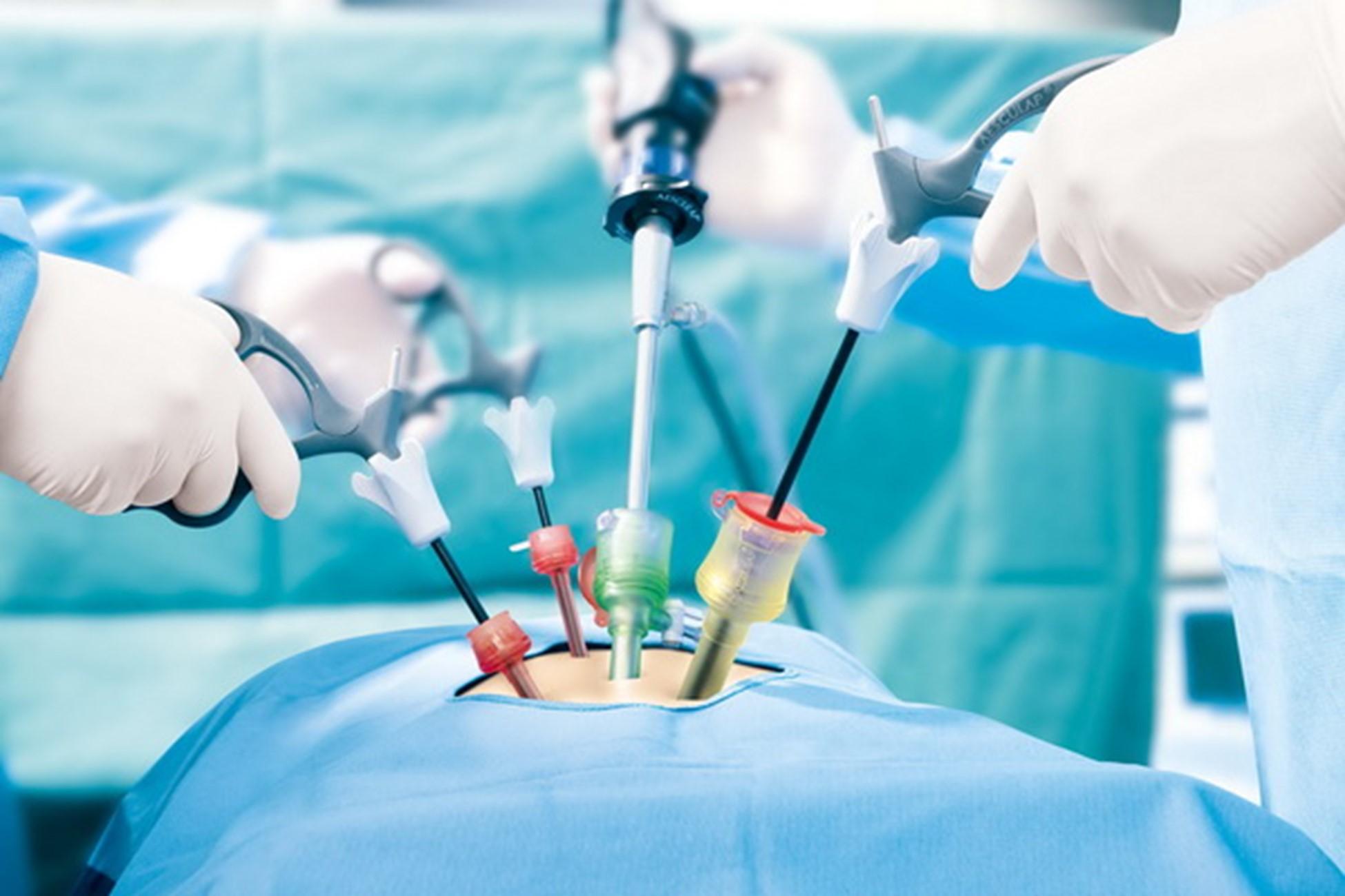 Laparoscopic surgery in progress — keyhole incisions and laparoscope camera view